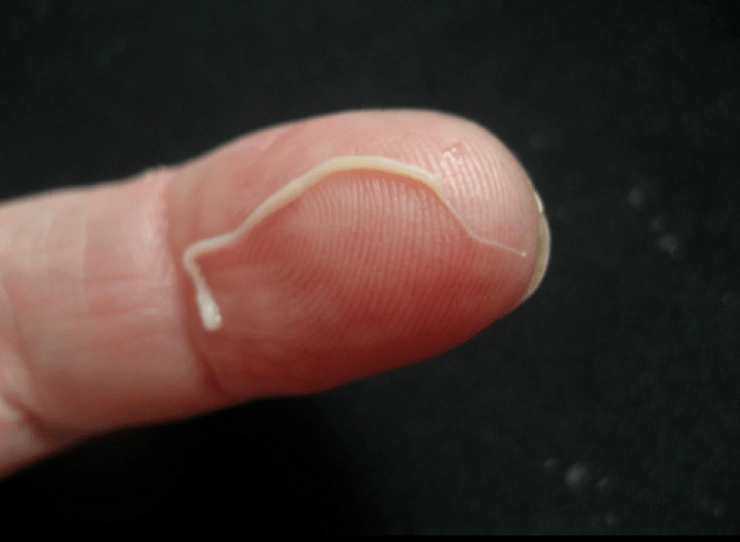 insan vücudundan çıkan yuvarlak kurt paraziti